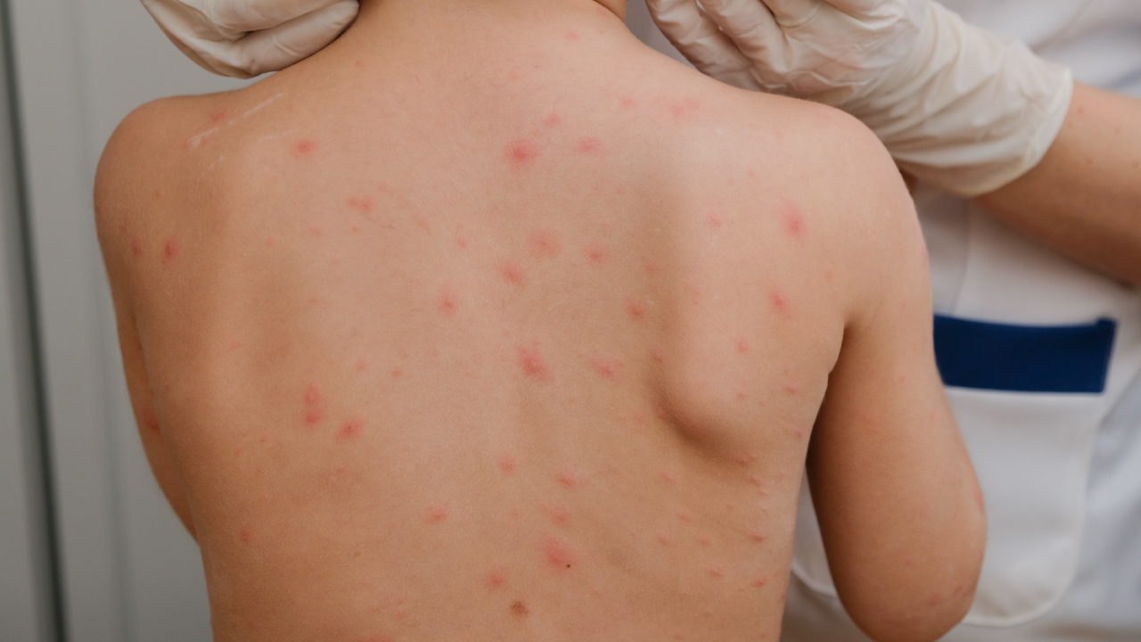 El Sarampión Resurge